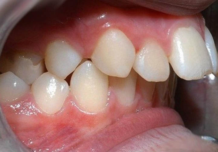 bọc răng sứ chữa hô