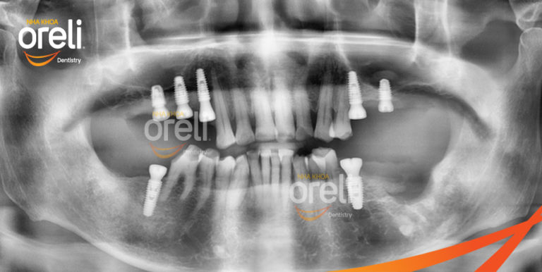 uu diem cay ghep implant