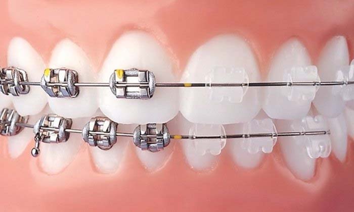 Các loại dây cung trong niềng răng