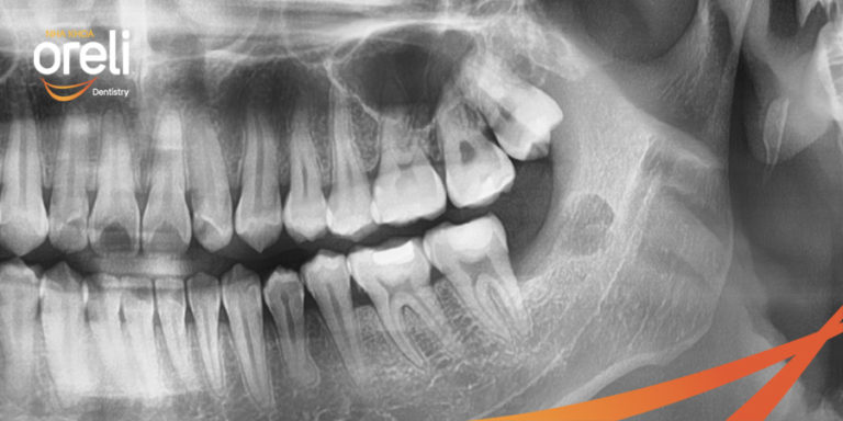 nho rang khon ham duoi