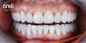 mat dan su veneer bmt