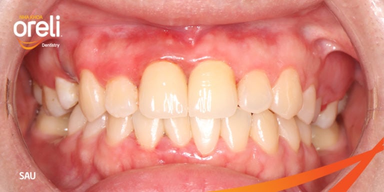 boc rang su uy tin oreli