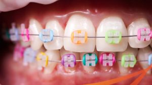 Niềng răng mắc cài sứ