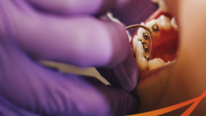 Niềng răng mặt lưỡi