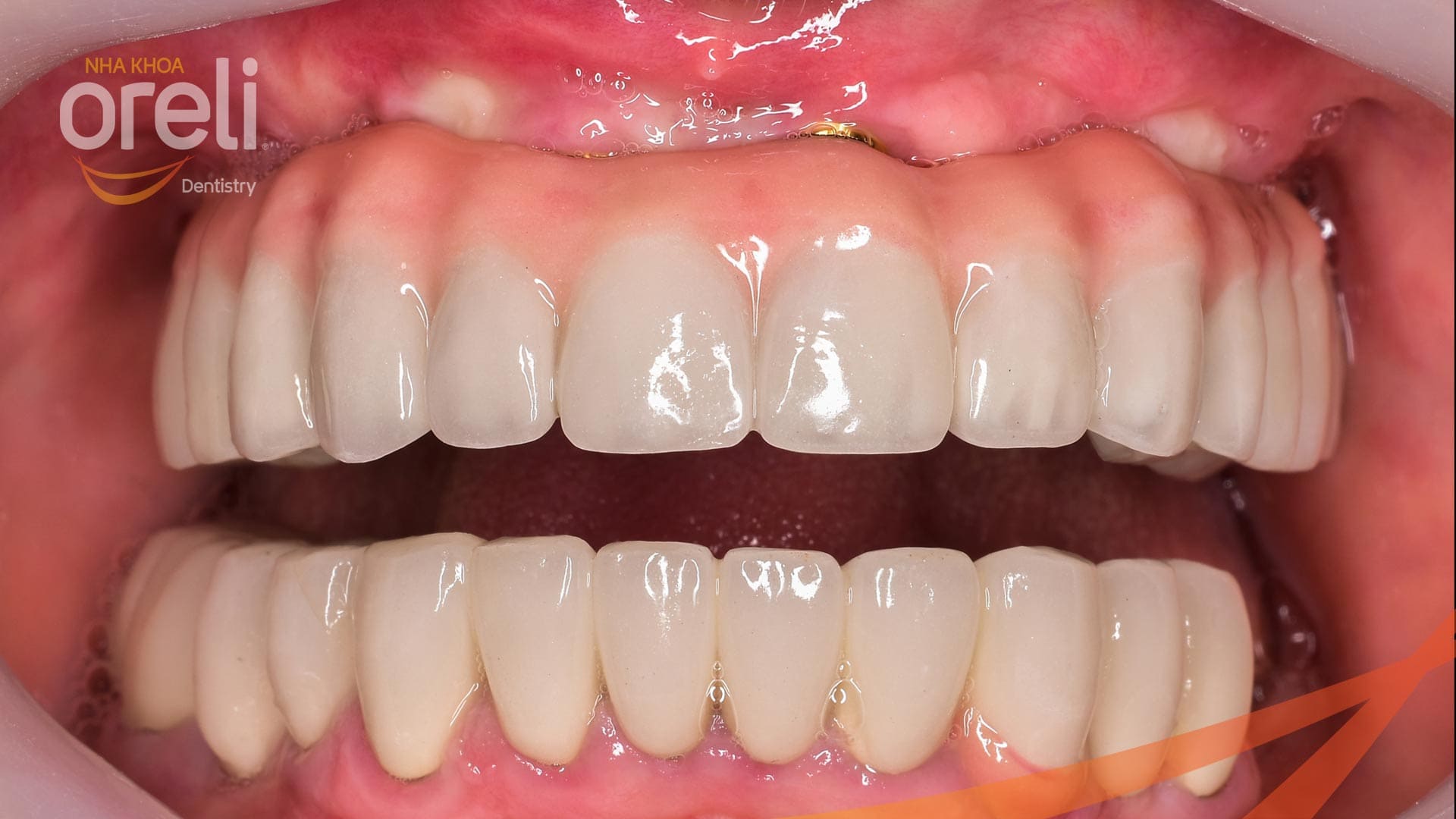 implant uy tin bmt