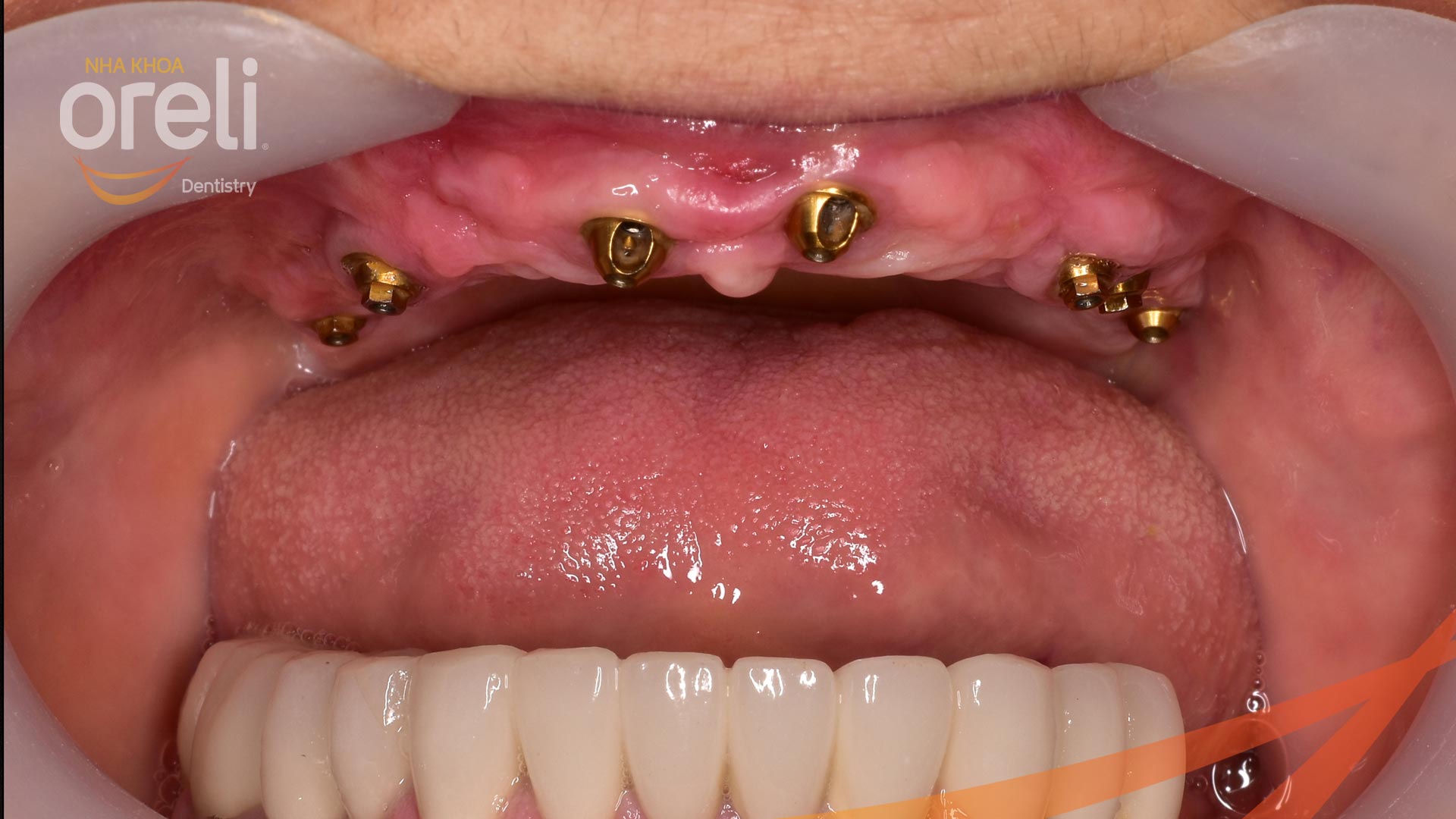 cấy implant uy tín bmt