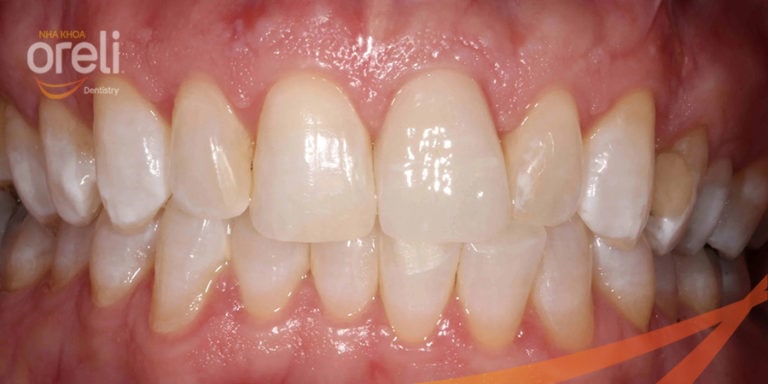 boc rang su uy tin bmt