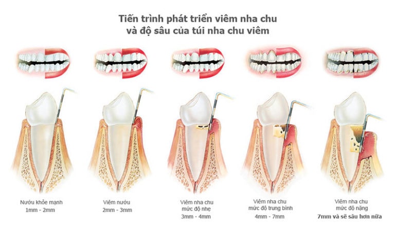 bệnh nha chu có chữa được không