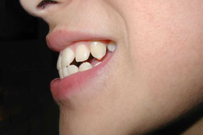 bị hô hàm có niềng răng được không