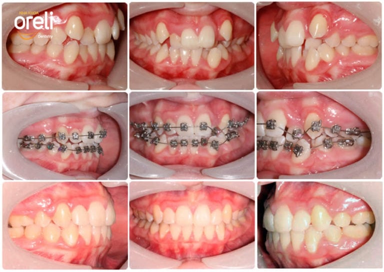 nieng rang mac cai tu khoa