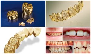 trồng răng vàng giá bao nhiêu