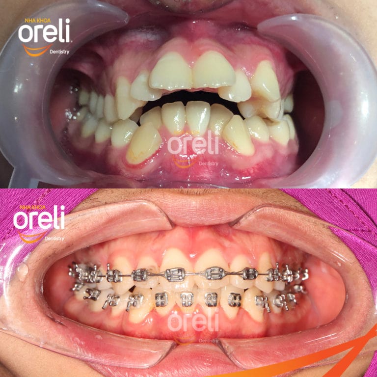 nieng rang uy tin daklak