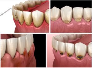 Chân răng bị đen thì phải làm sao