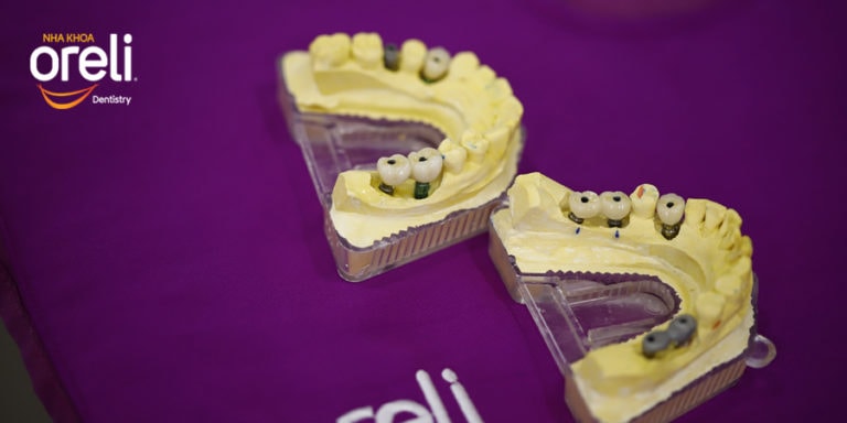 cay ghep implant o hai ham