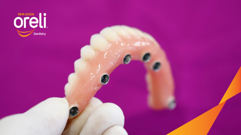 Tiêu xương hàm dưới sát ống thần kinh có trồng răng được không ? – Kết quả tại Oreli