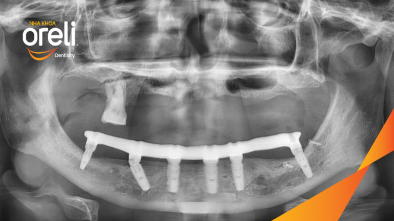 Tiêu xương hàm dưới sát ống thần kinh có trồng răng được không ? – Kết quả tại Oreli