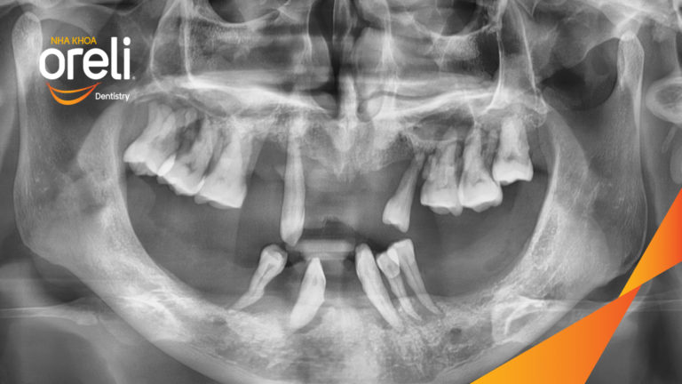 Tiêu xương hàm dưới sát ống thần kinh có trồng răng được không ? – Kết quả tại Oreli