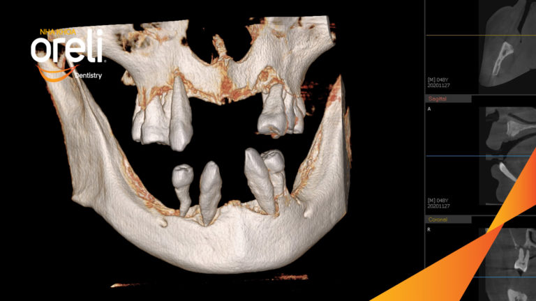 Tiêu xương hàm dưới sát ống thần kinh có trồng răng được không ? – Kết quả tại Oreli