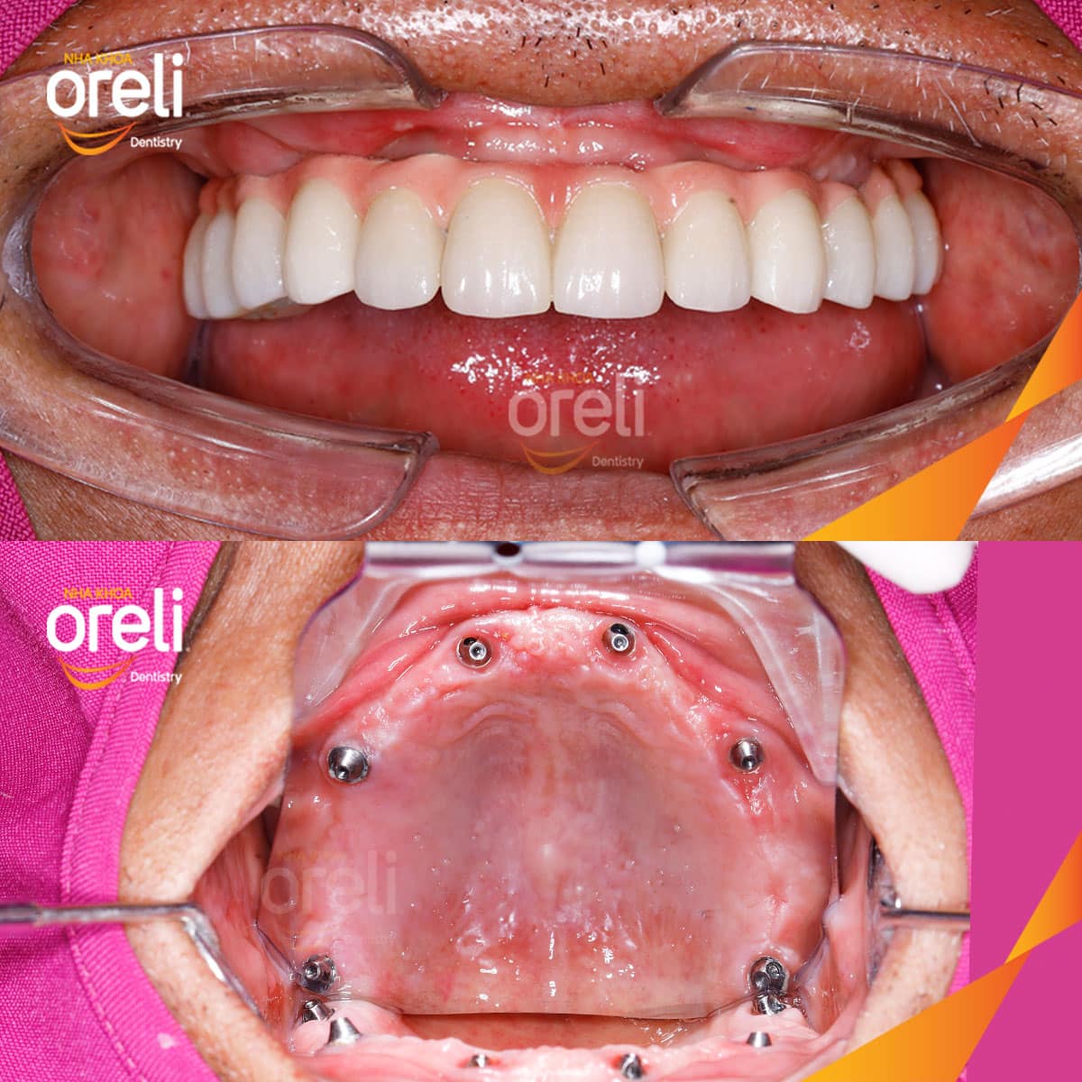 phục hình răng Oreli