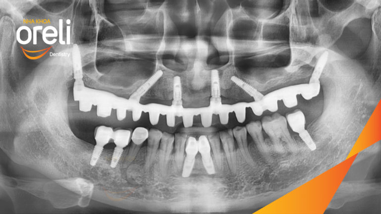 Trồng răng Implant hàm trên – Ăn nhai chắc chắn, nụ cười tự nhiên | Oreli