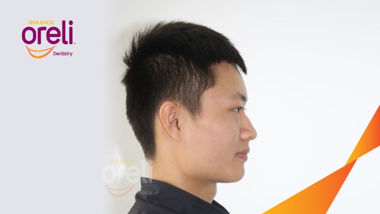 Ca niềng chỉnh cắn sâu hô lùi cằm cho kết quả nụ cười và góc nghiêng đẹp ở Oreli