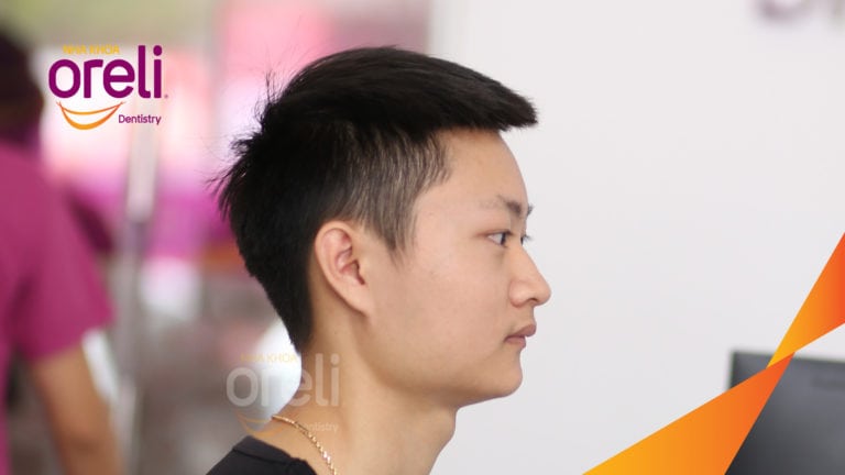 Ca niềng chỉnh cắn sâu hô lùi cằm cho kết quả nụ cười và góc nghiêng đẹp ở Oreli