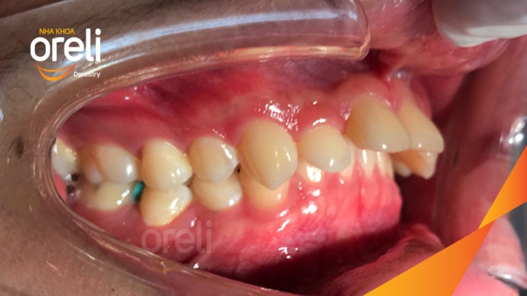 Ca niềng chỉnh cắn sâu hô lùi cằm cho kết quả nụ cười và góc nghiêng đẹp ở Oreli