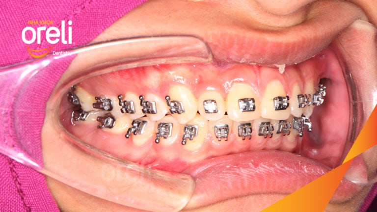 Ca niềng chỉnh cắn sâu hô lùi cằm cho kết quả nụ cười và góc nghiêng đẹp ở Oreli