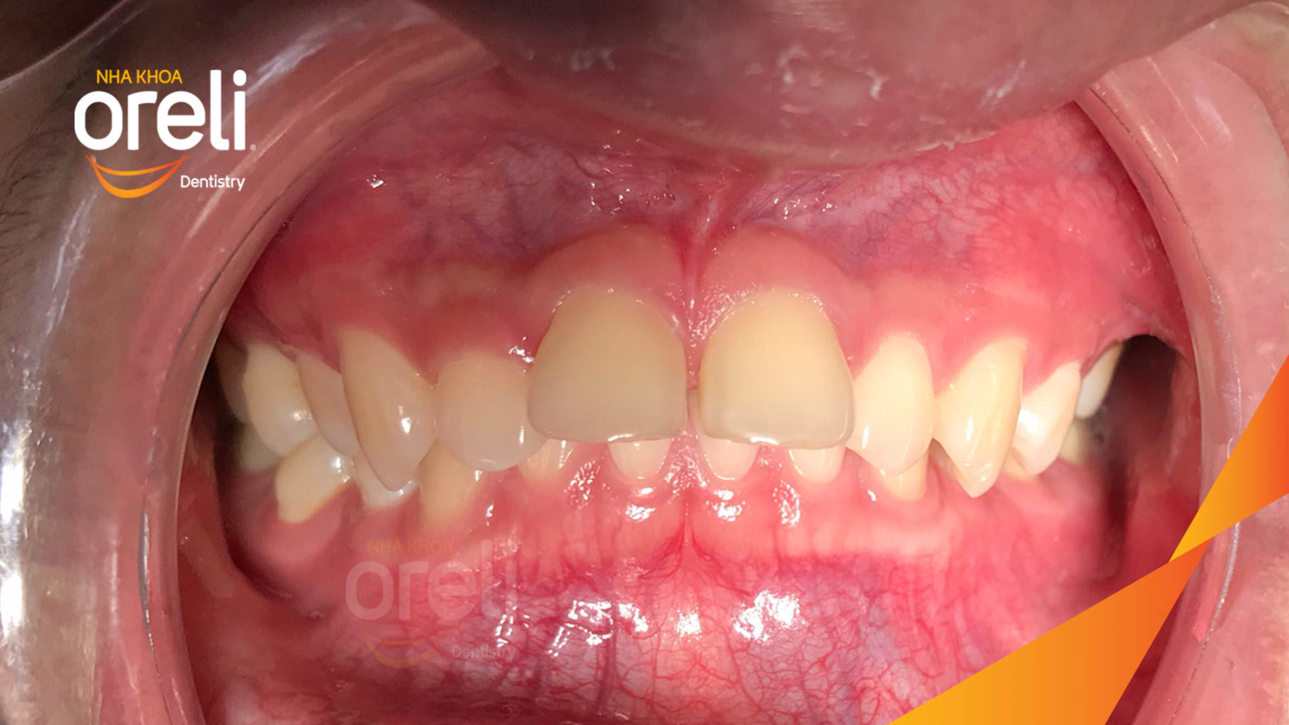 Kết quả sau 36 tháng: khớp cắn đúng, cằm tiến ra trước với mặt nghiêng đẹp tại Nha khoa Oreli