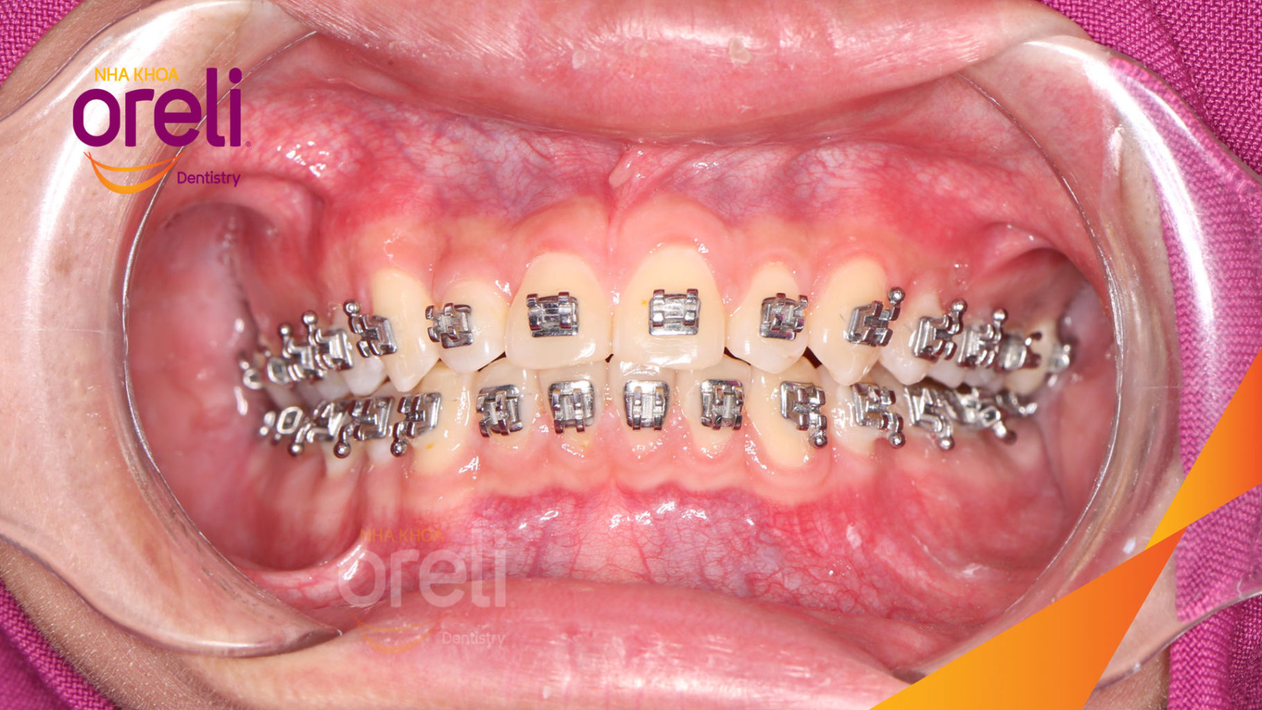 Kết quả đạt được sau 36 tháng - khớp cắn đúng, cằm tiến ra trước với mặt nghiêng đẹp tại Nha khoa Oreli