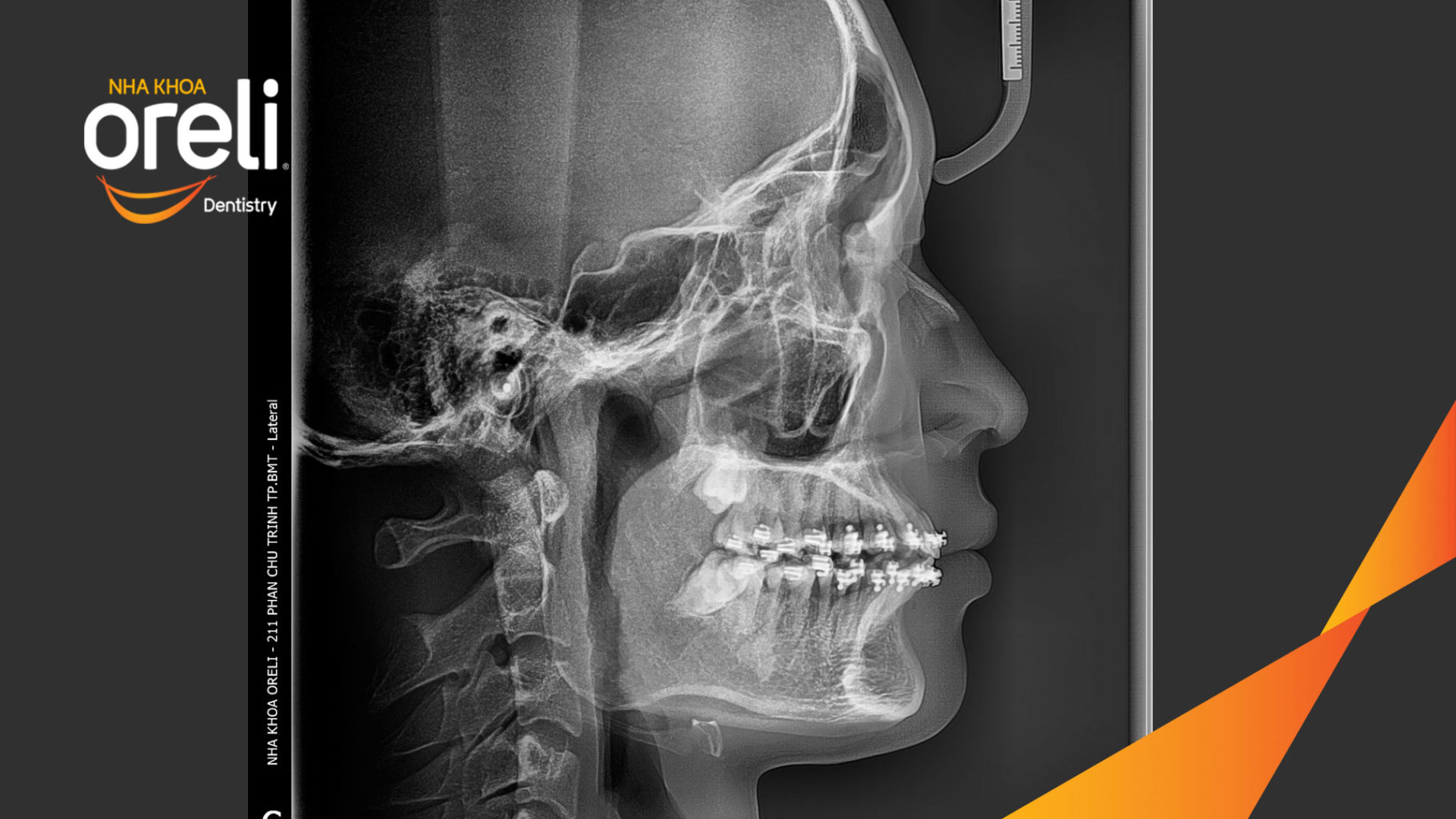  trước khi điều trị tại Nha khoa Oreli