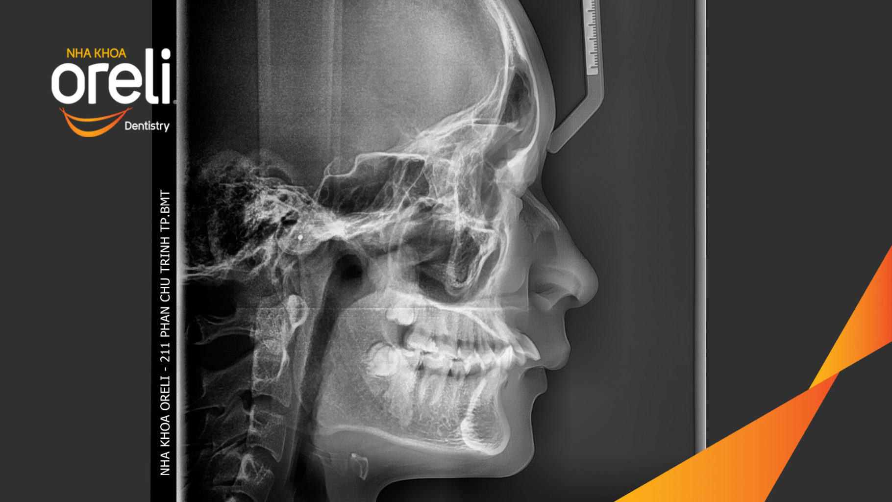 Trước điều trị:  tại Nha khoa Oreli