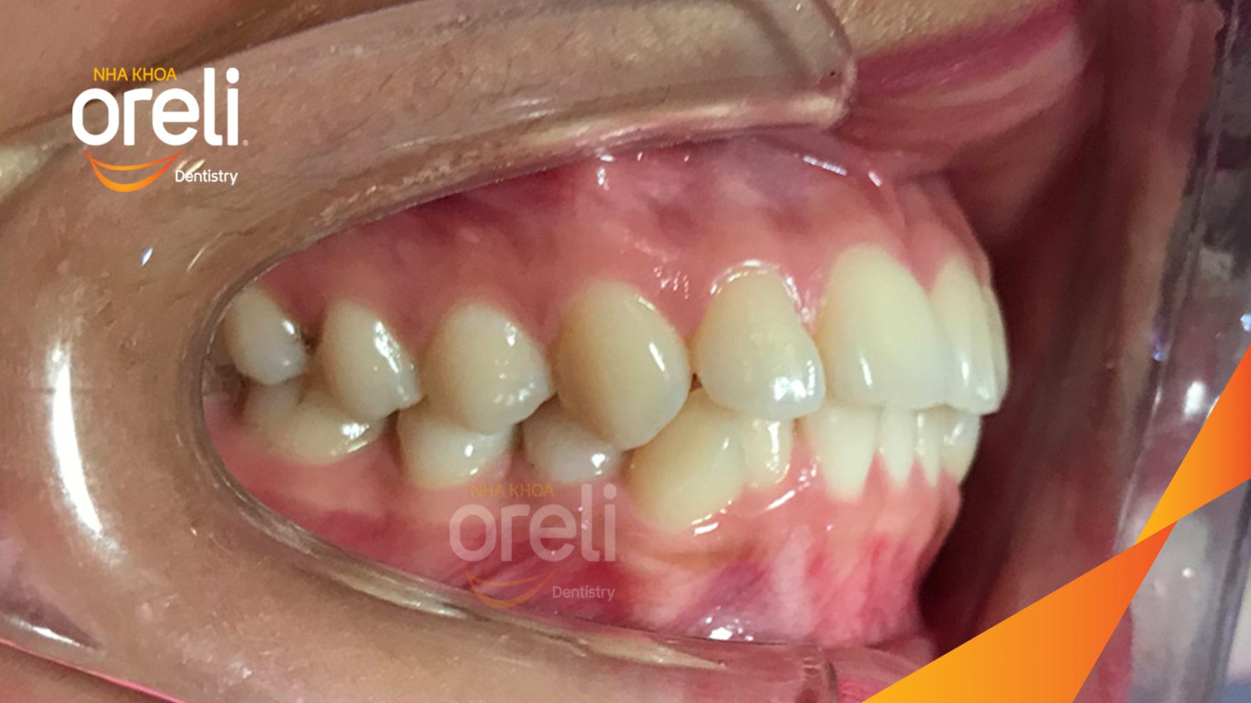 Niềng răng hô nặng phải nhổ 4 răng số 4 cho góc nghiêng và hàm răng đều đẹp – Hành trình tại Oreli