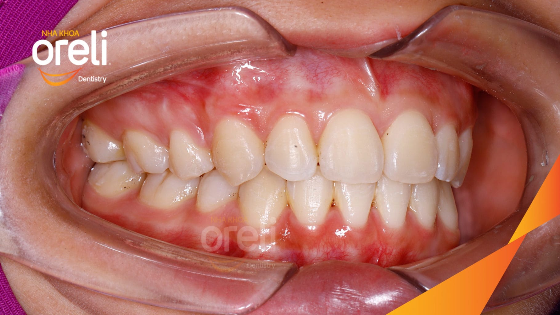 Niềng răng hô nặng phải nhổ 4 răng số 4 cho góc nghiêng và hàm răng đều đẹp – Hành trình tại Oreli