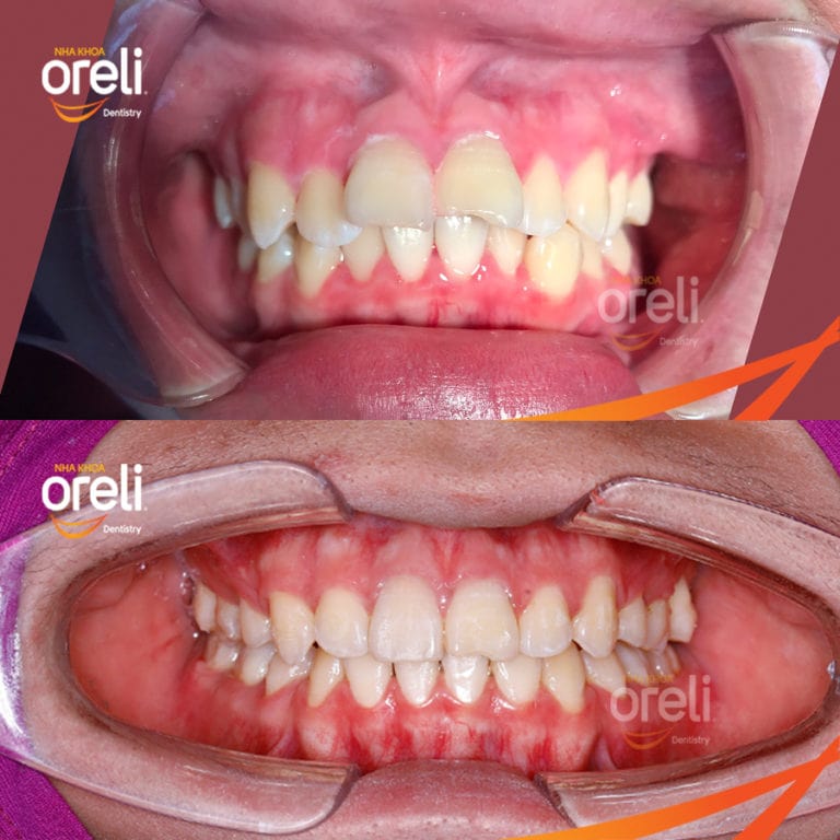 nieng rang ho uy tin daklak