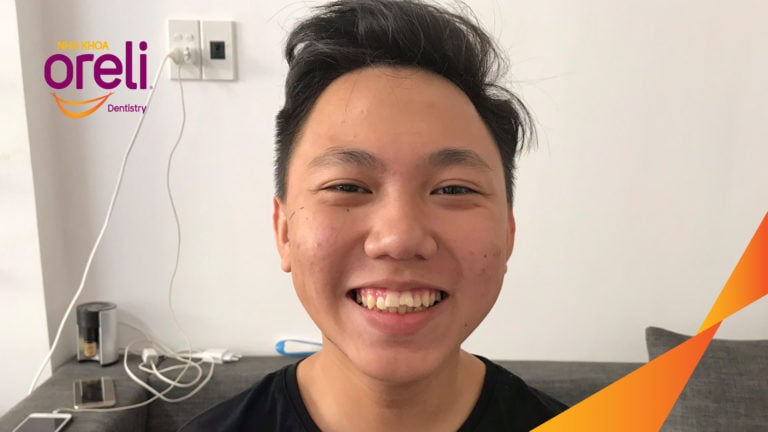 Ca niềng chỉnh hô thay đổi góc nghiêng đẹp kết quả thực tế tại Oreli