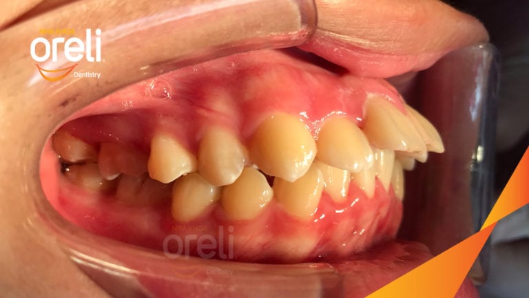 Ca niềng chỉnh hô thay đổi góc nghiêng đẹp kết quả thực tế tại Oreli