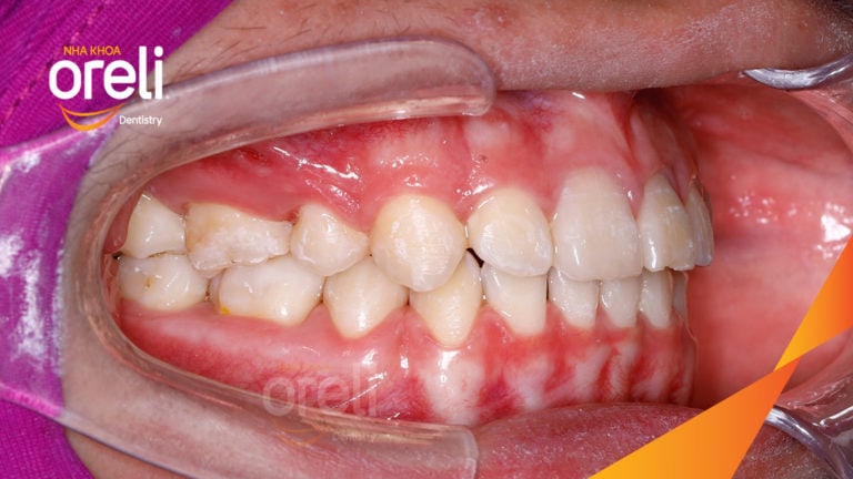 Ca niềng chỉnh hô thay đổi góc nghiêng đẹp kết quả thực tế tại Oreli