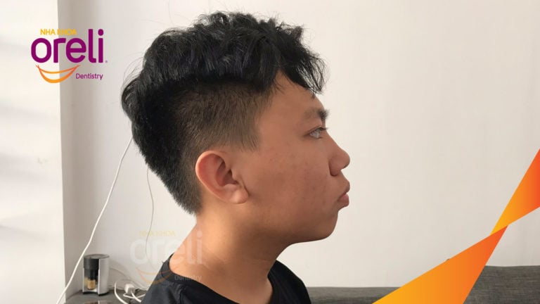 Ca niềng chỉnh hô thay đổi góc nghiêng đẹp kết quả thực tế tại Oreli