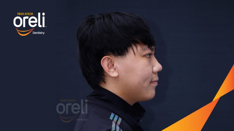 Ca niềng chỉnh hô thay đổi góc nghiêng đẹp kết quả thực tế tại Oreli