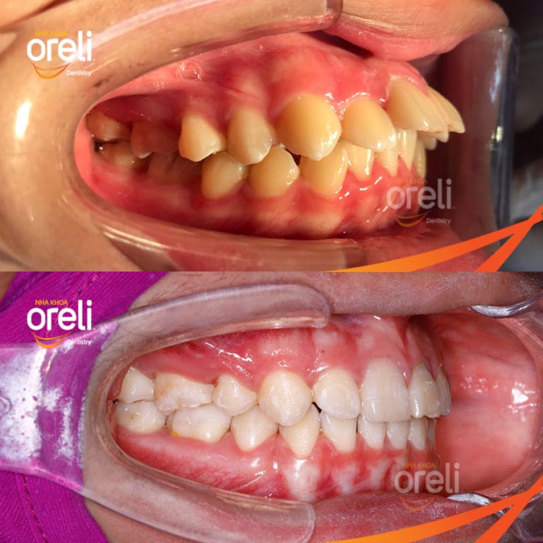 nieng rang ho nho 4 rang 4