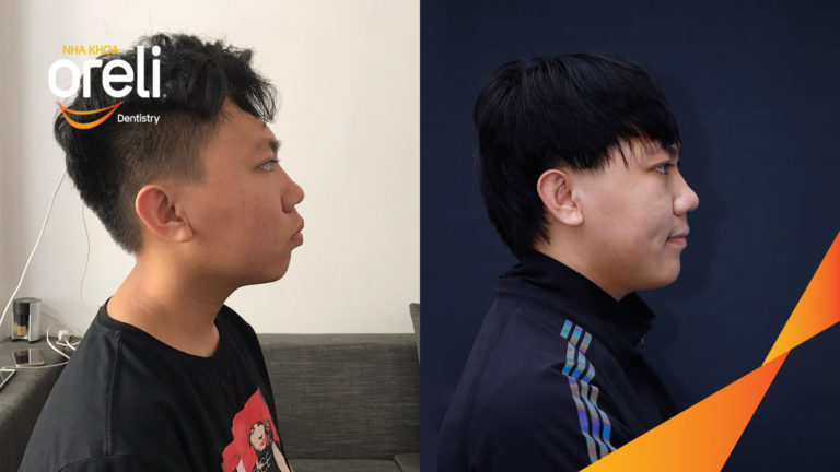 nieng chinh ho nho 4r4 oreli