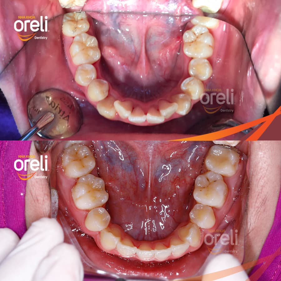 chỉnh hình răng Oreli