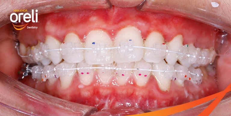 nieng rang mac cai su