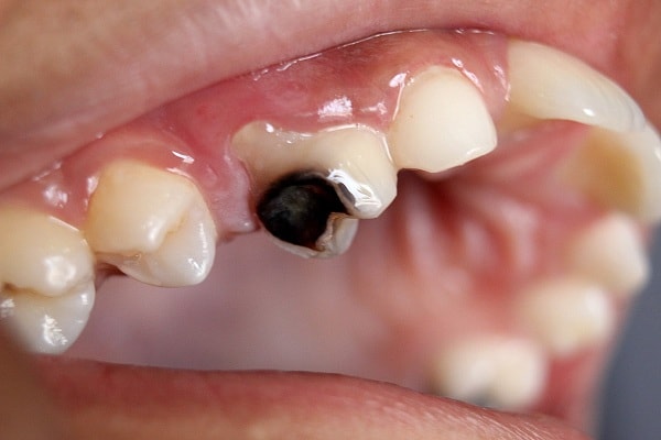 dấu hiệu nhiễm trùng răng