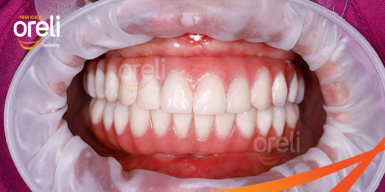 trong rang implant toan ham oreli