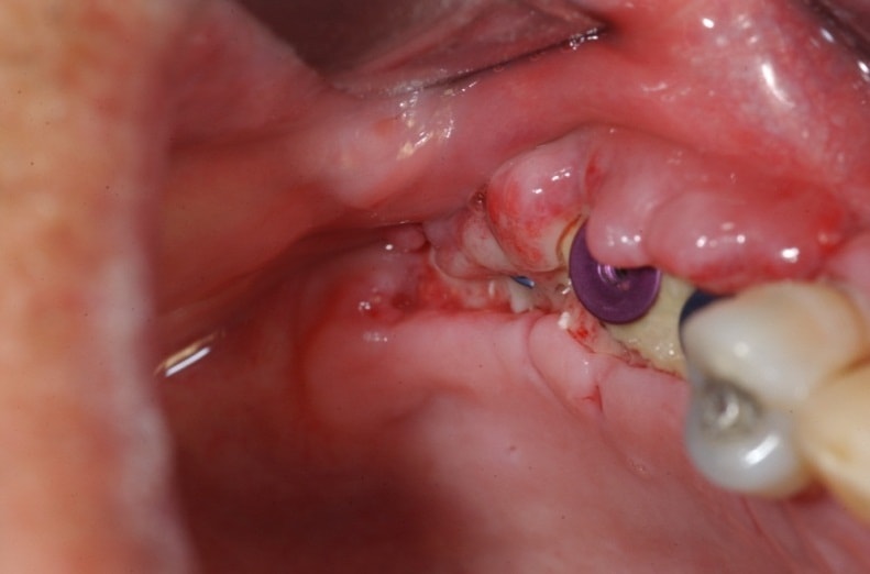 dấu hiệu nhiễm trùng răng
