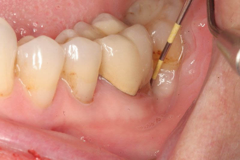 Cách chữa viêm chân răng