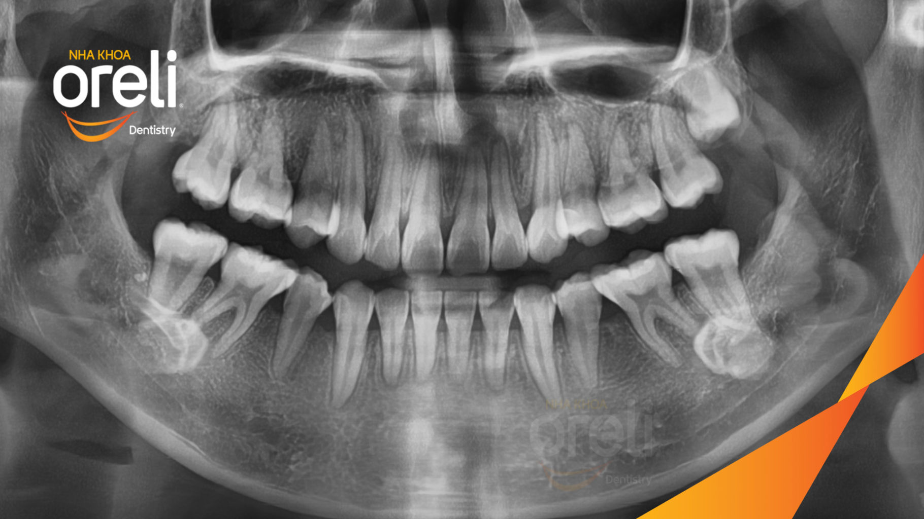  trước khi điều trị tại Oreli