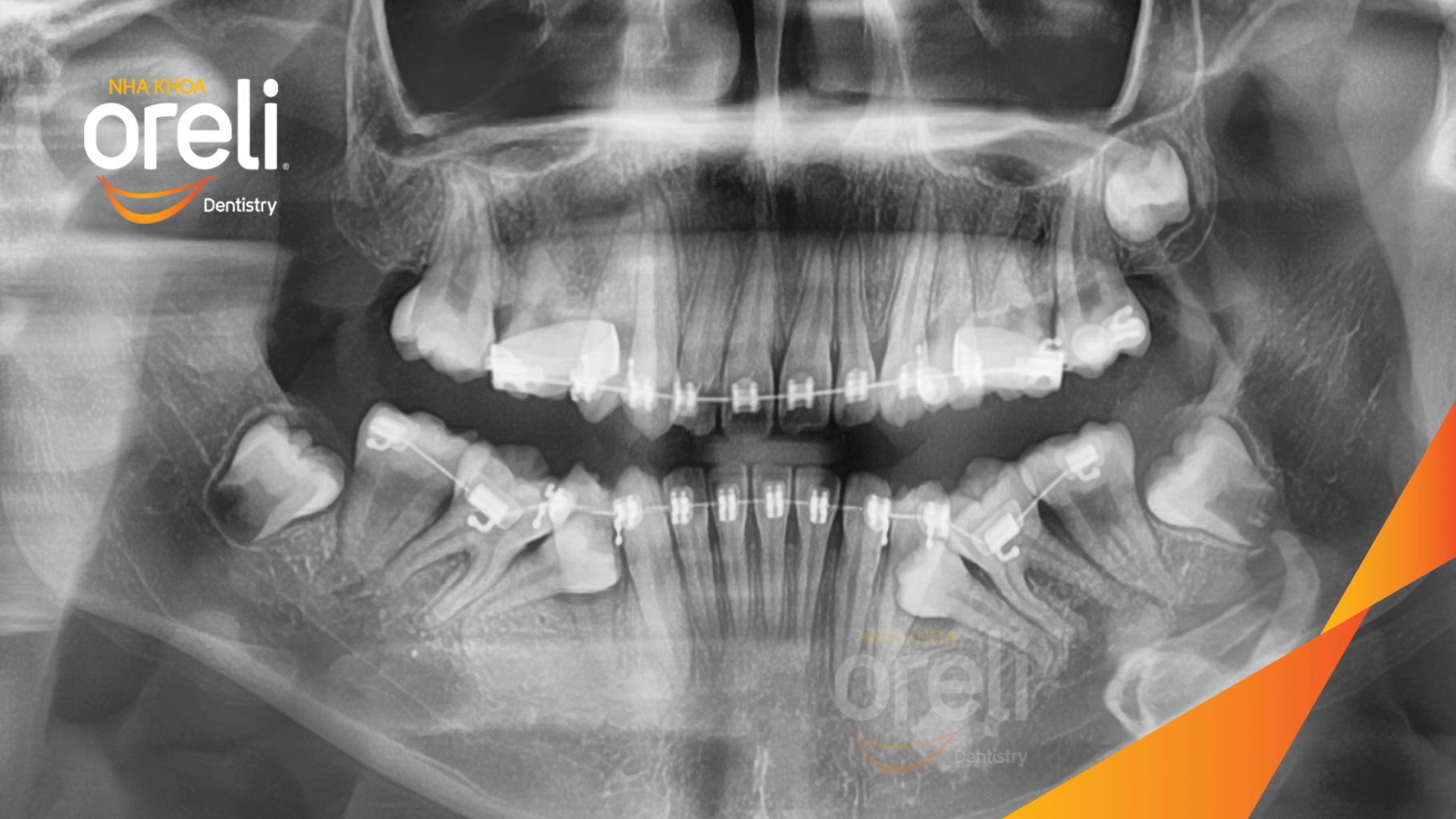 Trước điều trị:  tại Oreli